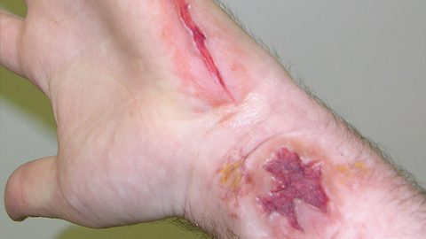如何直接在皮肤上制造假伤口和疤痕